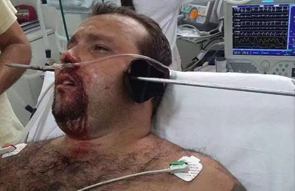 Fisherman Escapes Death After A Metal Pole Pierced Through His Head. Viewers Discretion